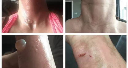 Vrouw leest voor gebruik de bijsluiter niet en heeft nu enorme blaren