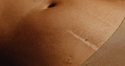 Hoe kun je de zichtbaarheid van een litteken wat vervagen?