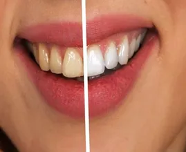 Queste cose possono far ingiallire i denti