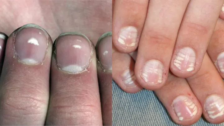 Wist jij al waar die witte vlekjes op je nagels vandaan komen? Wij nu wel!
