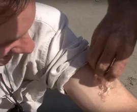 Das musst du tun, wenn du von einer Qualle gestochen wirst