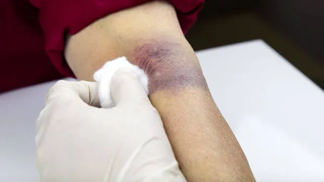 Met deze tip genezen je blauwe plekken veel sneller