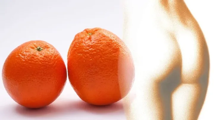 Você quer se livrar da sua celulite? Essas dicas podem ajudá-lo