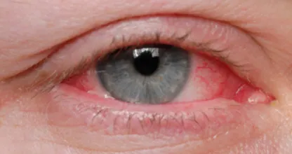 Leidest du unter trockenen und gereizten Augen? DAHER kommt es und DAS kannst du dagegen tun!