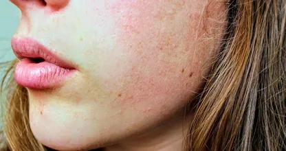 Diese 5 Hautprobleme deuten auf Vitamin D Mangel hin.