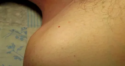 Dermatologen: dit is hoe die rode ‘moedervlekken’ verwijderd kunnen worden