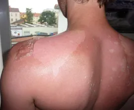 Dit is de reden waarom je nooit velletjes van een verbrande huid moet trekken
