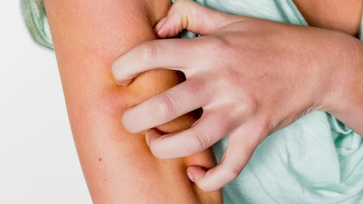 5 manieren waarop je lichaam kan reageren op een muggenbeet
