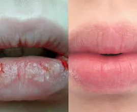 Machen dir trockene, spröde und eingerissene Lippen im Winter auch zu schaffen? DAS ist der Grund!