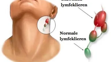 Ook vaak een bult achter je oor? Wij gingen op onderzoek uit en DIT betekent het!