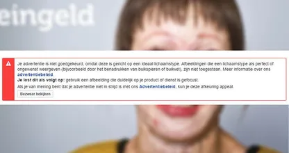 BIZAR: deze advertentie van Brandwonden Stichting wordt geweigerd op Facebook!