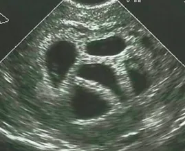 This mom refused to abort her quintuplets. Twenty years later, she shows this picture! Wow, this is amazing!