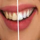 歯を黄色くさせる原因となるものを徹底解説