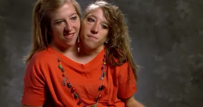 Years after these Siamese twins were born, they shared shocking news