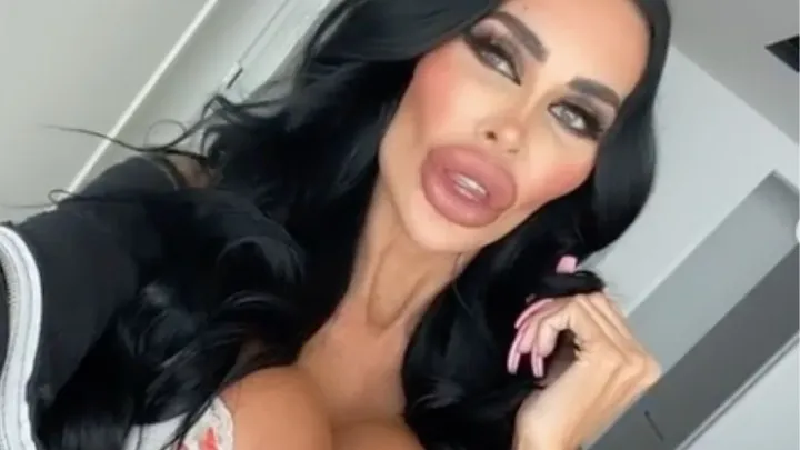 Shocking: vrouw telt 62.000 euro neer voor plastische chirurgie