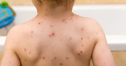 Apenpokkenvirus voor het eerst vastgesteld bij een kind in Nederland