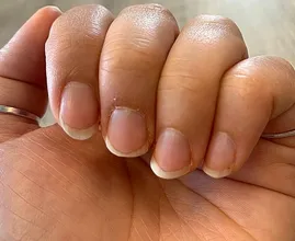 Last van een nagelriemontsteking? Dit is alles wat je erover moet weten