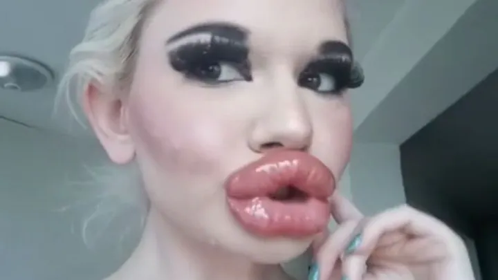 Shocking: jonge vrouw liet lippen twintig keer opspuiten