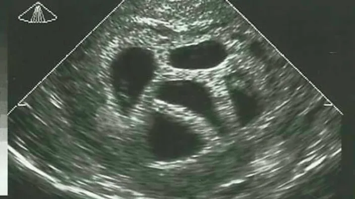 Deze moeder weigerde een abortus van haar vijfling en laat 20 jaar later DEZE foto zien! Wauw!