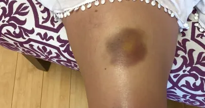 Five reasons why some people bruise so easily 