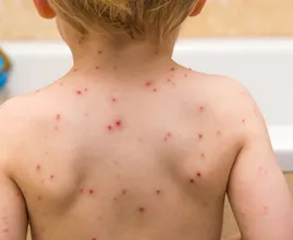 Apenpokkenvirus voor het eerst vastgesteld bij een kind in Nederland