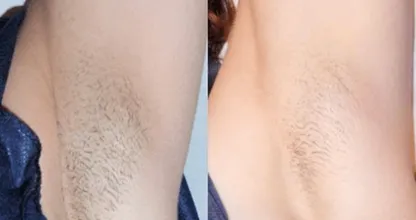 Wil je snel en eenvoudig van je okselhaar afkomen? Probeer DIT natuurlijke middel eens!