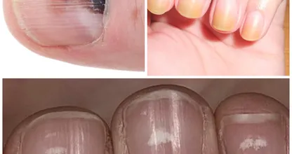 Weiße Linien, gelbe Nägel oder dunkle Flecken? DAS sagt es über deine Gesundheit aus!