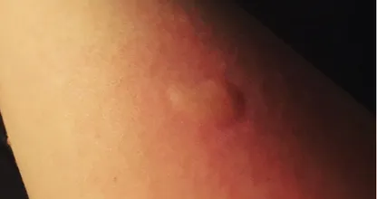 Durch die tägliche Einnahme von diesem Vitamin wirst du diesen Sommer NICHT von Mücken gestochen!