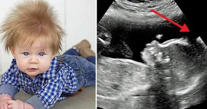 De enorme haardos van deze baby was al zichtbaar op de echo! Heb jij ooit zoiets gezien?!