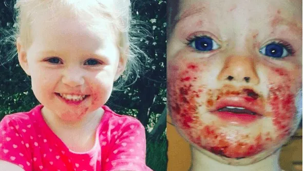 Wat afschuwelijk dit... een familielid met herpes verwoestte het gezicht van 3-jarige Sienna!