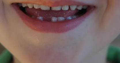 Bewahre die Milchzähne deiner Kinder unbedingt auf! Sie könnten ihnen eines Tages das Leben retten.