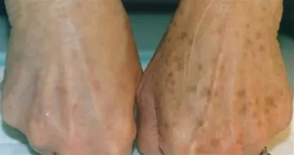 ¿Tienes manchas de edad en tu piel? Así desaparecerán enseguida
