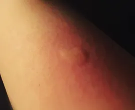 Durch die tägliche Einnahme von diesem Vitamin wirst du diesen Sommer NICHT von Mücken gestochen!