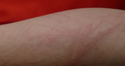 Zo herken je winterjeuk en zo genees je het