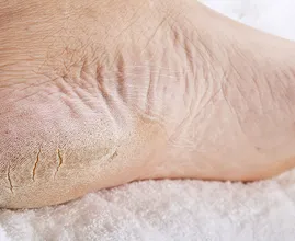 Annoying and painful: heel fissures! This natural remedy brings instant relief