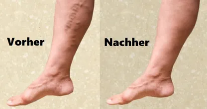 Mit diesem Trick wirst du deine Krampfadern leichter wieder los!