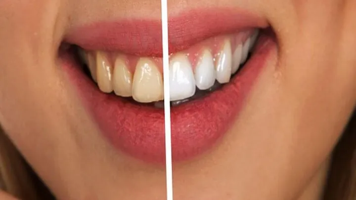 Queste cose possono far ingiallire i denti