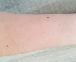 Heb jij moedervlekken? Naar aanleiding van dit onderzoek hebben we heel goed nieuws voor je!