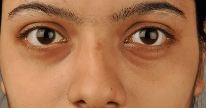 Vaak donkere kringen onder je ogen? Probeer dan deze drie dagelijkse gewoonten af te leren
