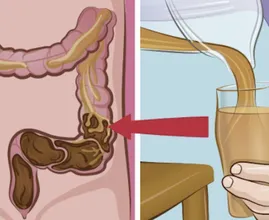 Reinige deinen Dickdarm! Nehme bis zu 9 Kilo ab und entgifte deinen Körper mit diesem Getränk.