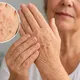 Haz que las manchas de la edad sean cosa del pasado - La gente abandona las cremas caras por este sencillo truco para las manchas oscuras