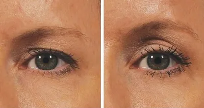 ¿Sufres de párpados caídos? ¡Entonces echa un vistazo a ESTA maravilla! ¿Levantamiento natural con...?