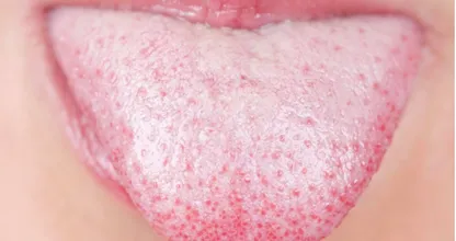 THIS is what a white tongue says about your health! Very few people know this!