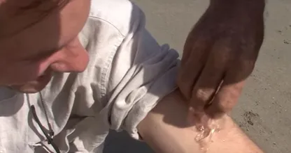 Das musst du tun, wenn du von einer Qualle gestochen wirst