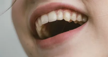 5 natuurlijke geneesmiddelen voor tandvleesontsteking