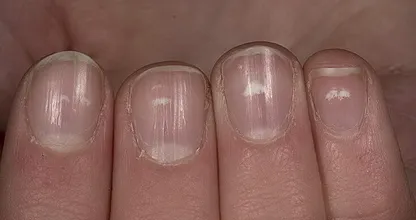 Wist jij al waar die witte vlekjes op je nagels vandaan komen? Wij nu wel!