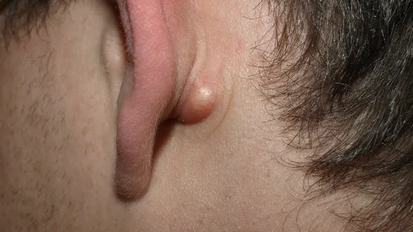 Do you sometimes have a strange little bump behind your ear? THIS is what it means!