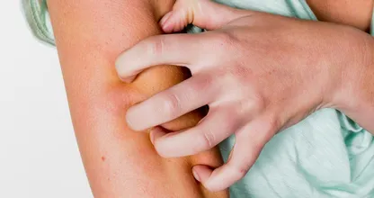 5 manieren waarop je lichaam kan reageren op een muggenbeet