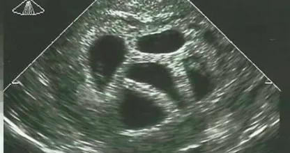 Esta madre se negó a abortar sus quintillizos. Veinte años después, ¡muestra esta imagen! ¡Wow esto es increíble!
