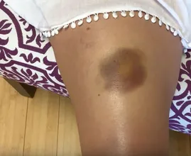 Five reasons why some people bruise so easily 